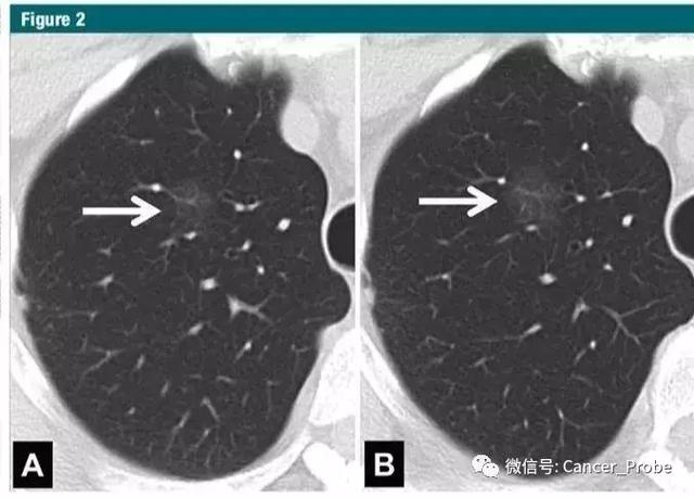 5mm磨玻璃结节良性几率图片