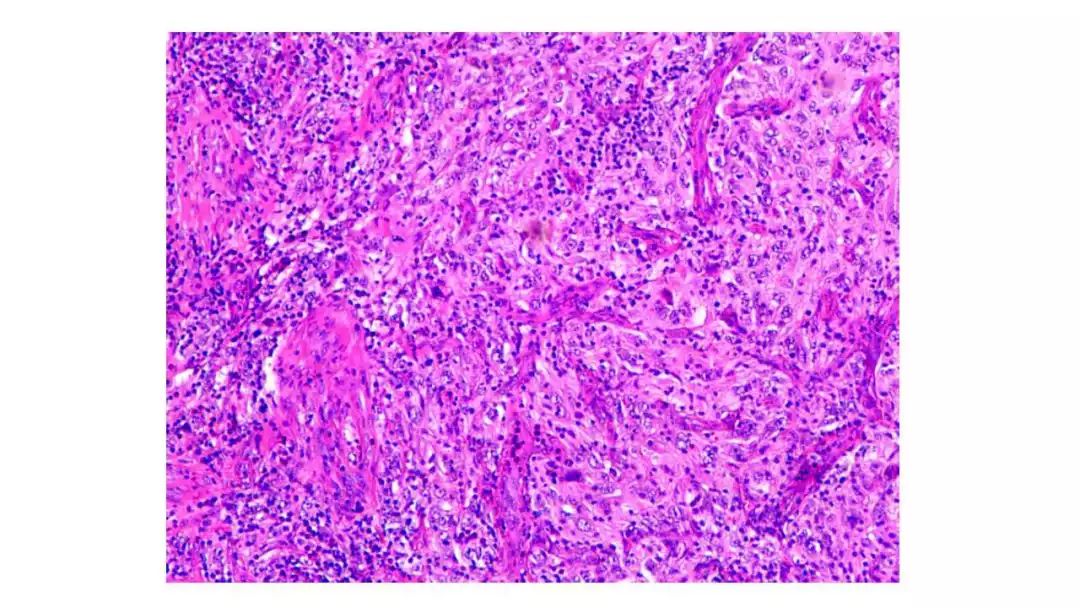 扁桃体肿物病例讨论