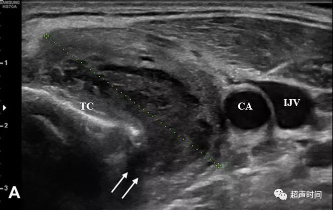 超声高手进阶累及甲状腺的梨状隐窝瘘