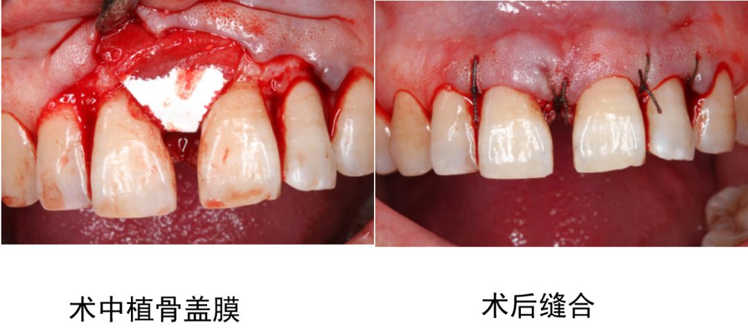 gtr术后2年影像学检查3对该病例的总结牙周牙髓联合病变的治疗关键