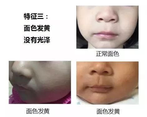 孩子咳嗽终于好了这个办法比雾化管用100倍后悔知道晚了