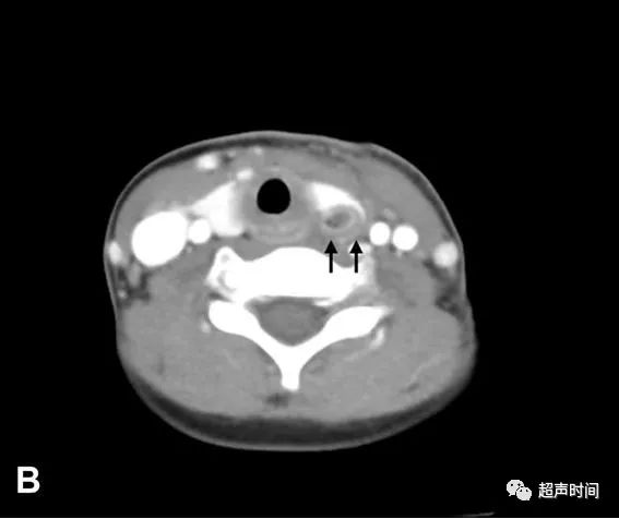 提示梨状窝瘘;图 1b ct 断层图像显示累及甲状腺的脓肿
