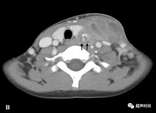 超声高手进阶累及甲状腺的梨状隐窝瘘