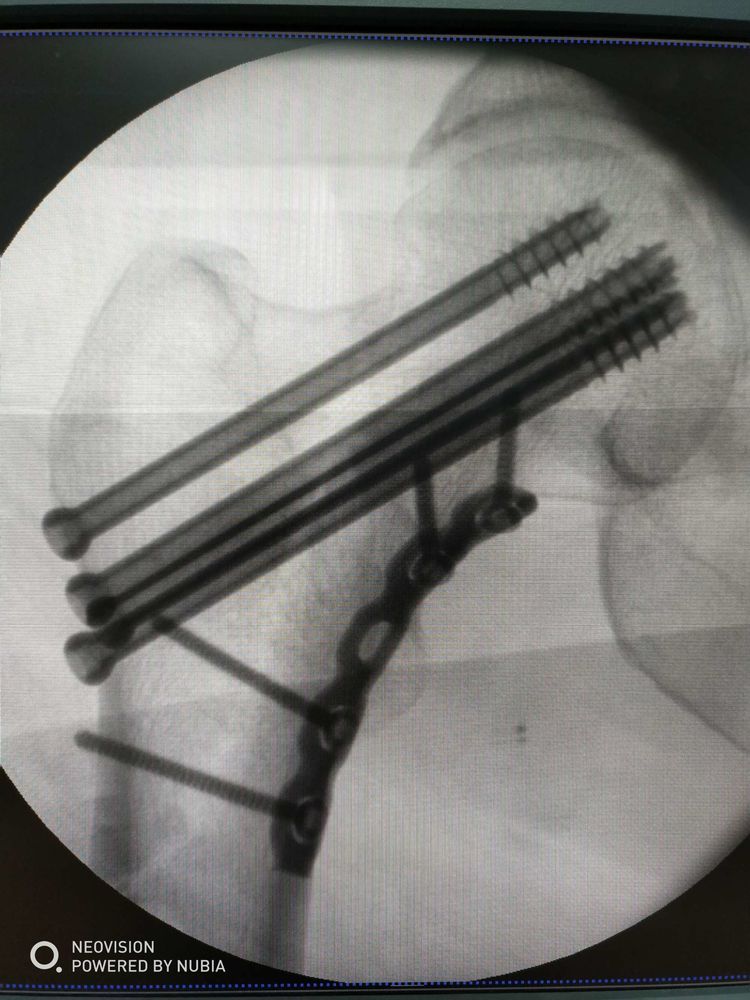 陝西中醫藥大學附屬醫院一例剪切型股骨頸骨折病例分享