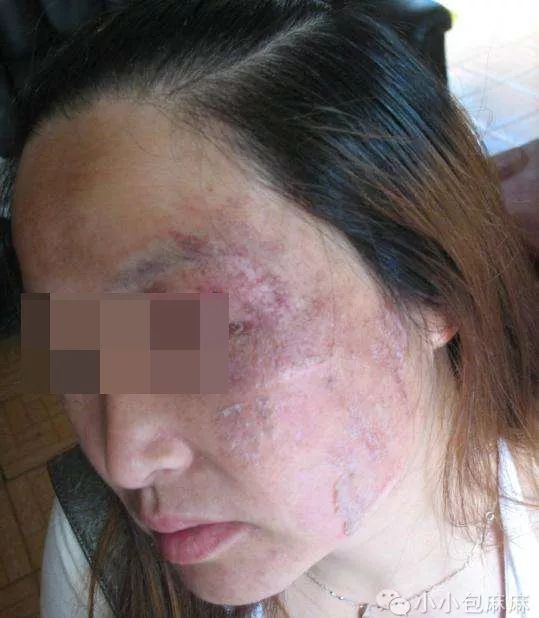 医生看见她时也是一脸惊讶:"眼缝周围的皮肤不断破溃流水,整个右眼