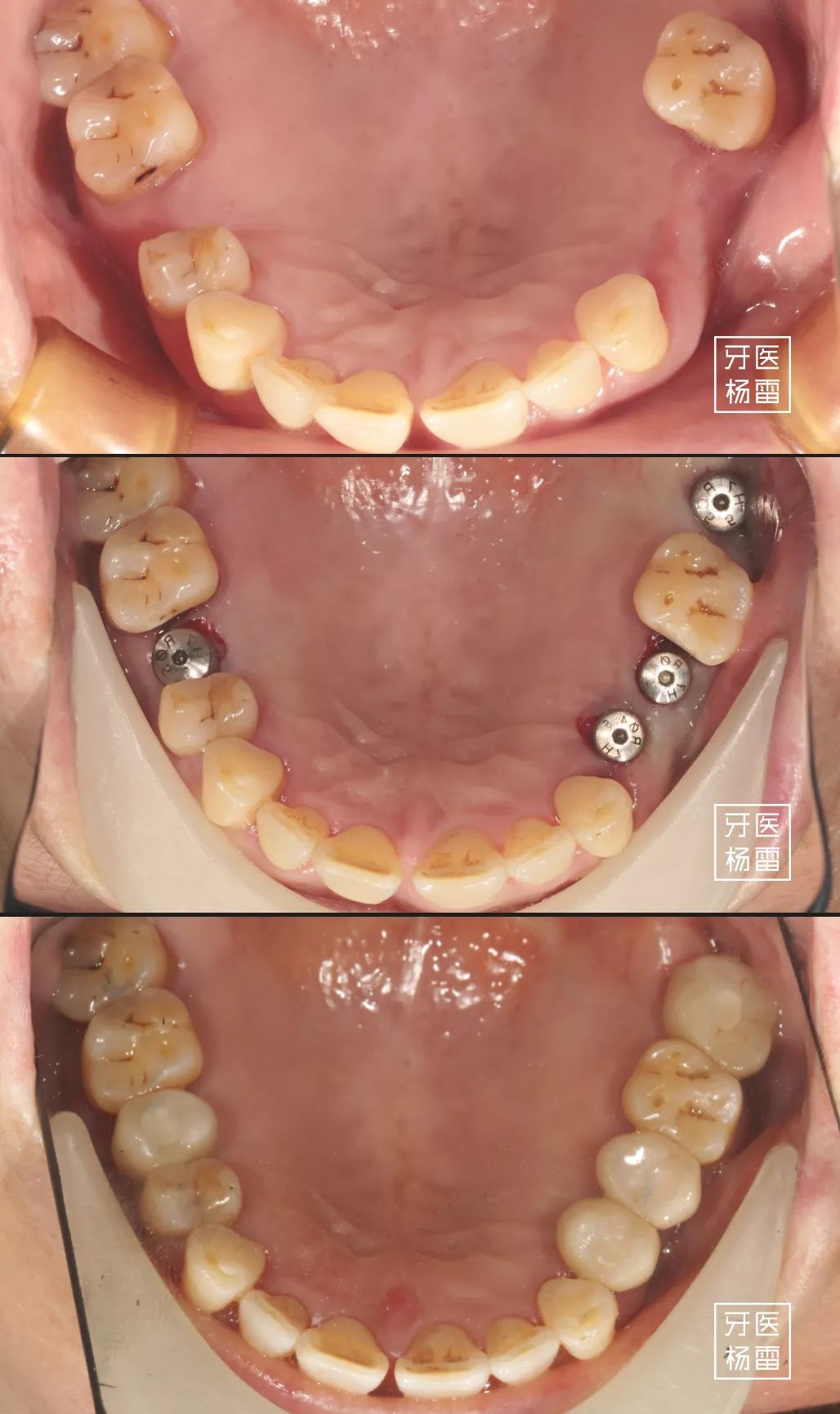 去美容院花47万做的种植牙,没多久全部破损