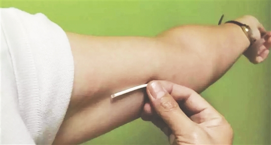 当心微商版埋线避孕正往你的身体里埋雷