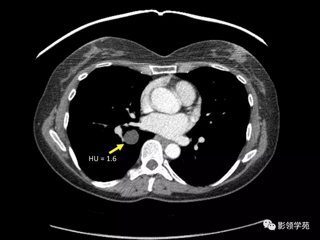 胸部x线显示右下叶内侧可见边界清晰结节——肺内支气管原囊肿