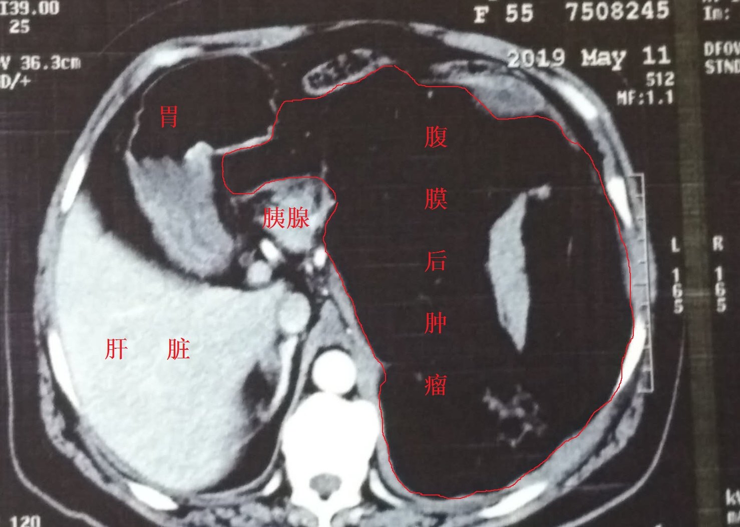 一例巨大腹膜后肿瘤合并自发性破裂大出血的患者获得成功救治 (原创)
