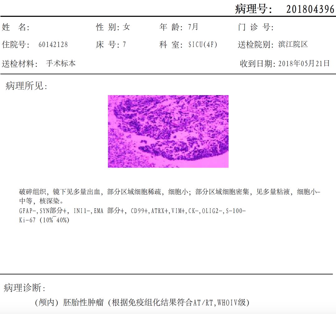 术后病理报告提示:胚胎性肿瘤,免疫组化结果:gfap -,syn部分 ,ini1