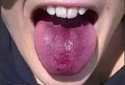 伸出"舌头"知百病!快找个镜子自测一下,只需一分钟!