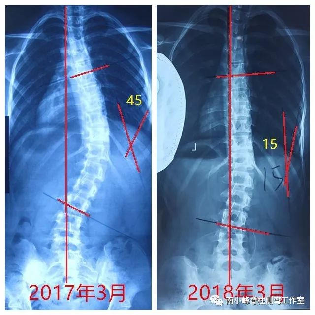 脊柱侧弯度数一年前后对比带支具后的状态一年前后体表对称度改善目前