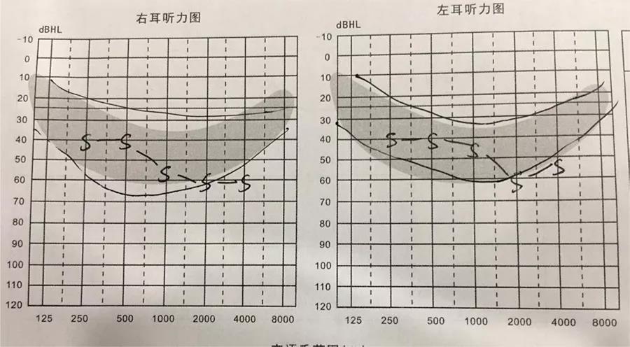 听力图陡降型的听损患者该如何选择助听器?