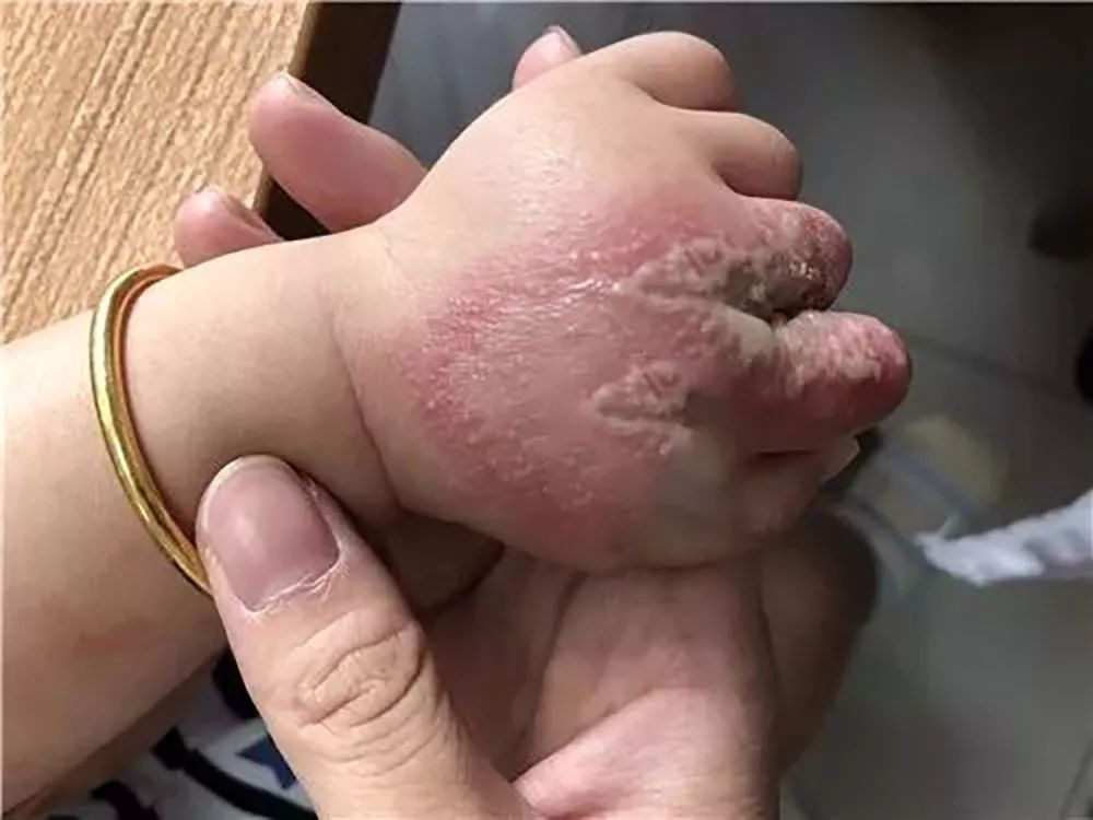 随手拍死一只小虫一觉醒来半边脸烂了夏天千万小心