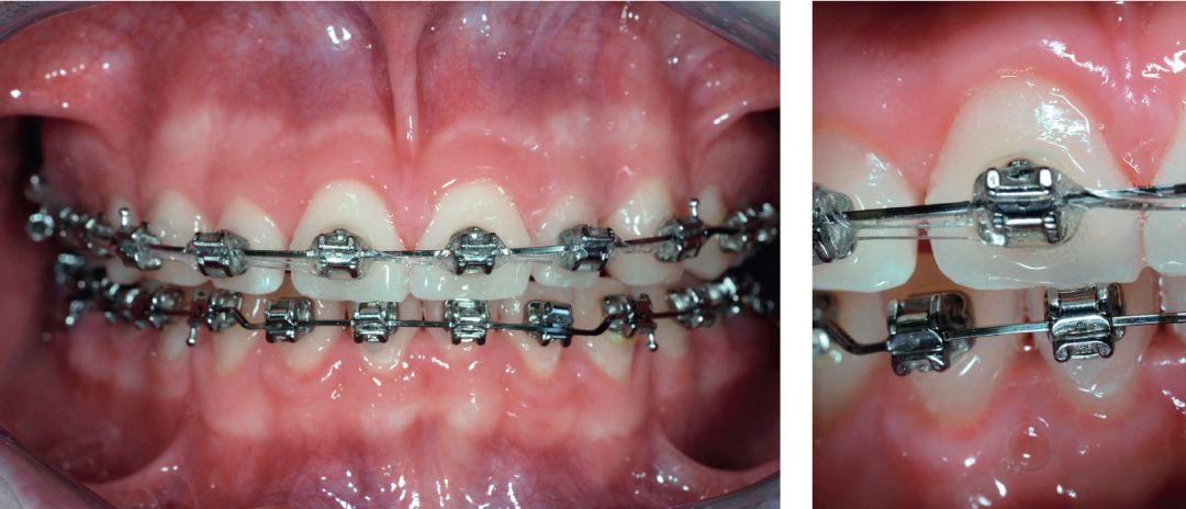 了解正畸可能产生的副作用釉质磨损折裂和正畸作用力和牙根吸收