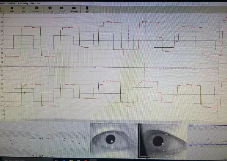 眼震电图检查目的图片