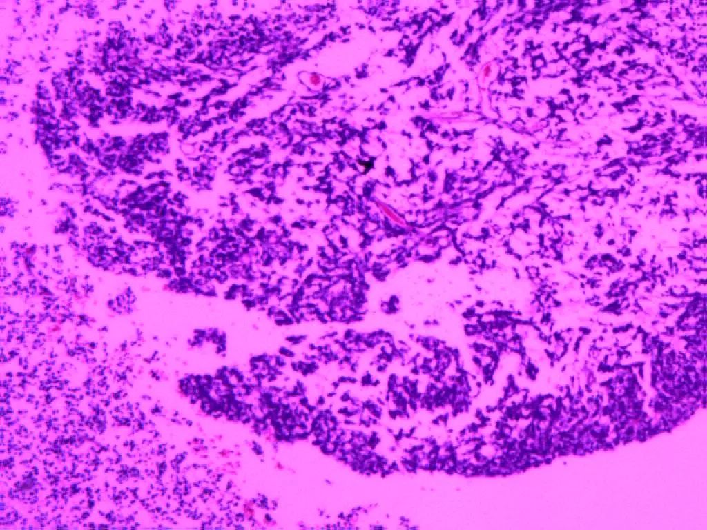 儿童颅内非典型畸胎样/横纹肌样瘤一例(小儿神经外科系列七)---浙二神