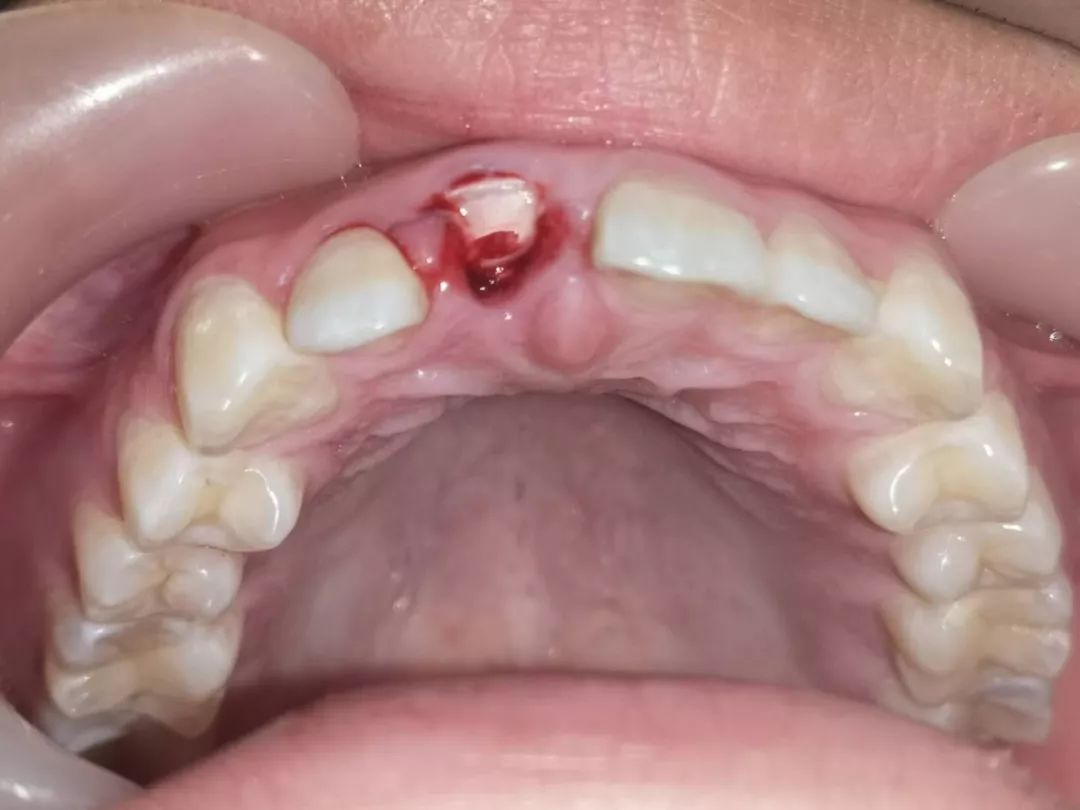 整牙能成功吗，有没有整牙后变更丑的案例?_牙齿不齐-深圳爱康健口腔医院