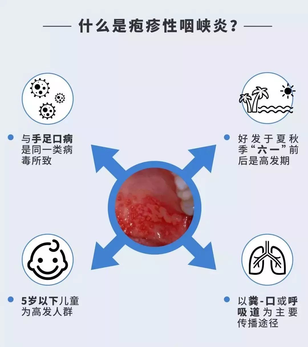 皰疹性咽峽炎(herpangina)是由腸道病毒引起的以急性發熱和咽峽部皰疹