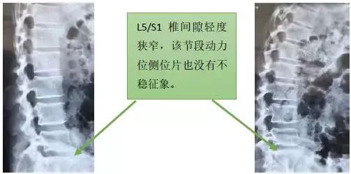 為什麼我不建議這位年輕人做脊柱融合手術