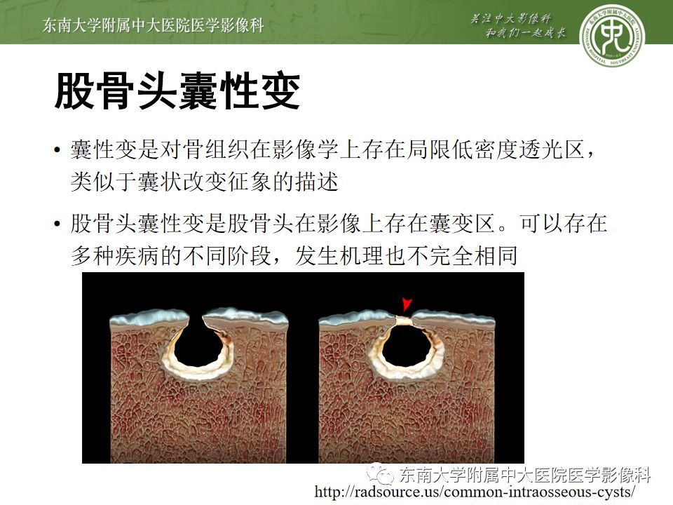 病例结果:左侧股骨头缺血性坏死伴股骨颈骨髓水肿编辑/校对:郑孝飞mr