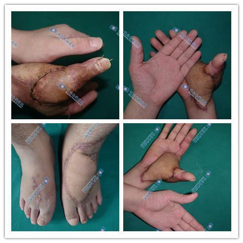 拇指断离千万别截肢,这样做就能活