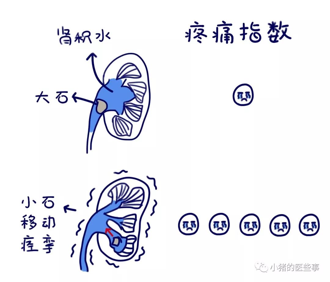 在三個狹窄處容易發生阻塞引起症狀當腎結石排出時由於輸尿管有三個