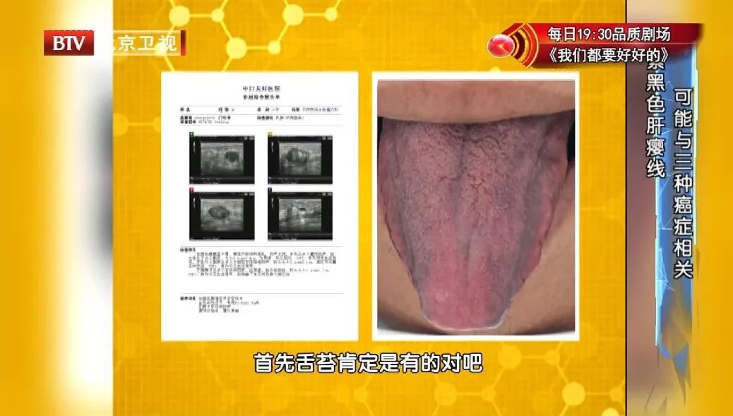 有这3种舌象,当心癌症找上门!舌头与癌症有这样的关系!_舌苔