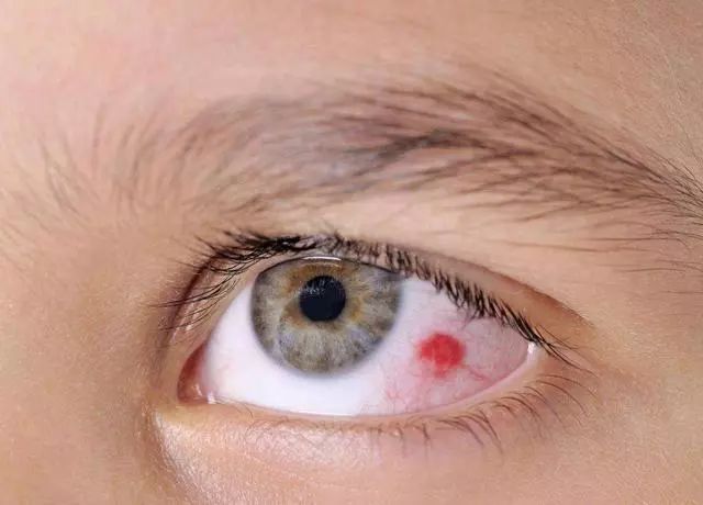 小心高血压也是伤害眼睛的隐形杀手