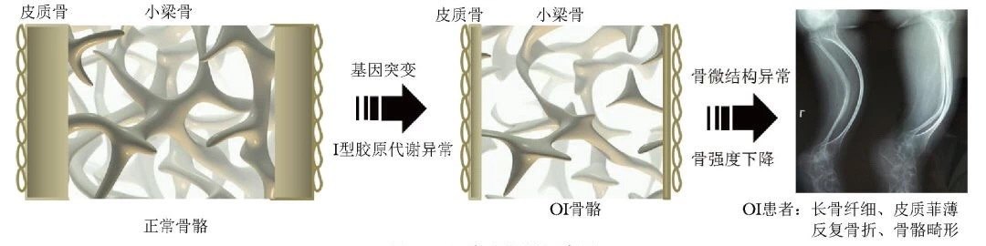 2019成骨不全症临床诊疗指南 (转载)