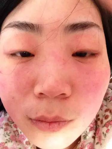 什么是油敏?什么是激素敏?