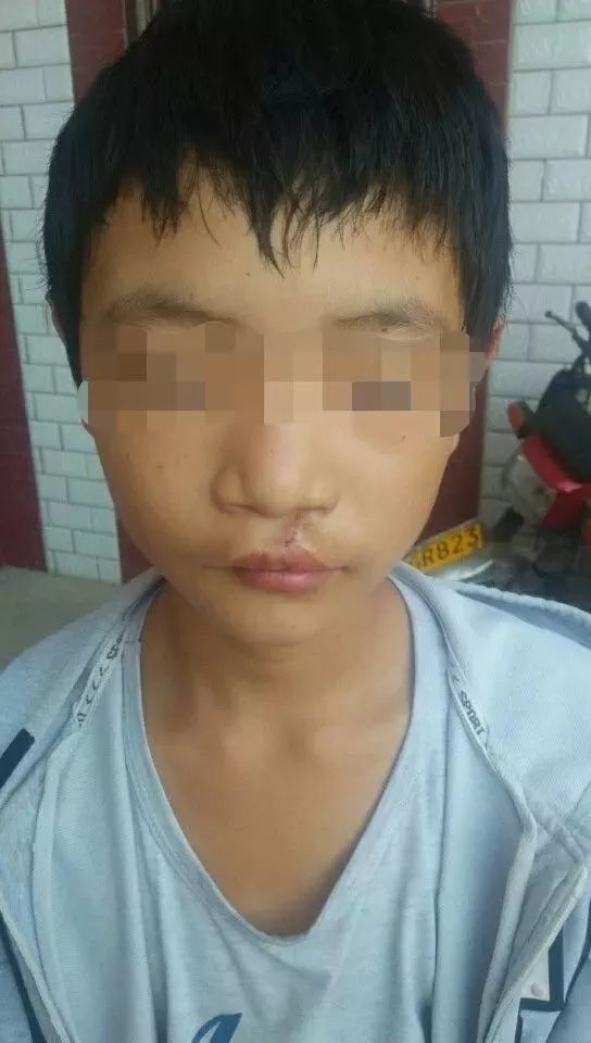 以微笑的名义 让阳光照亮残缺 —会东县2019年首批唇腭裂患者手术成功