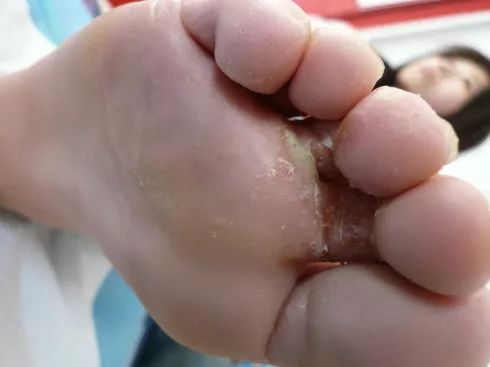 风靡全欧洲的脚气水,一喷就见效,20年顽固脚气也能救!l好物推荐