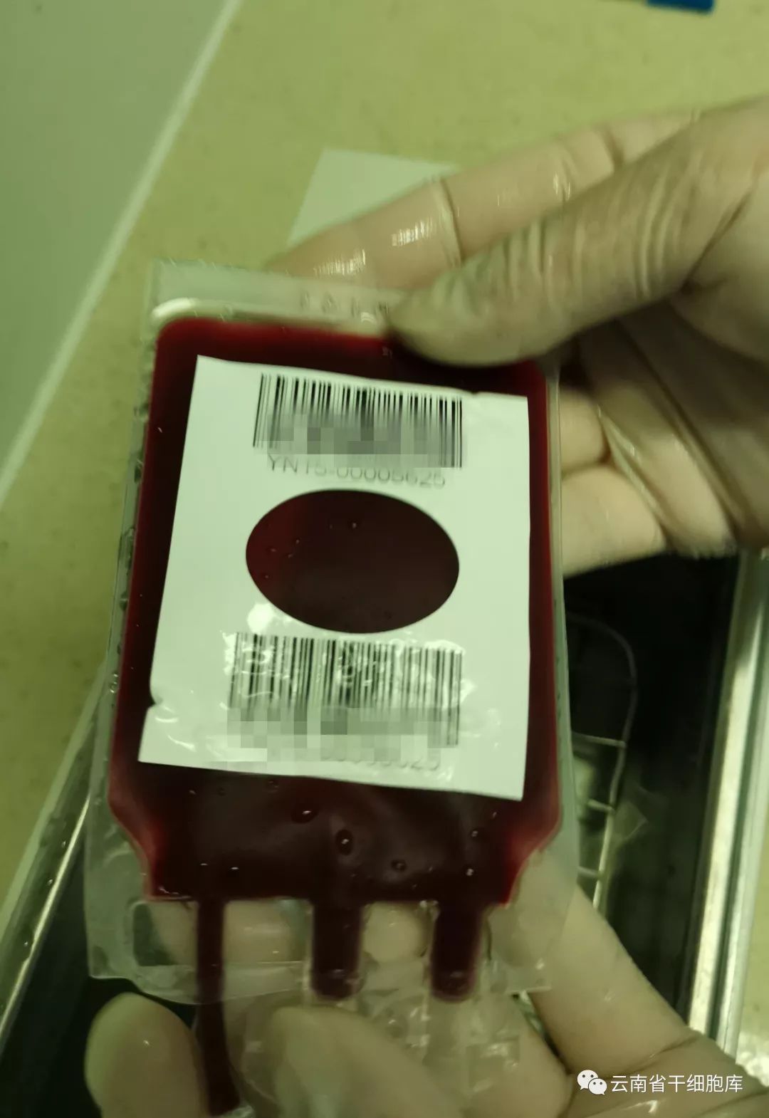 中源协和旗下干细胞库脐带血出库治疗重型地中海贫血症