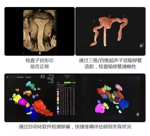 检查目的不同,妇科四维超声的最佳检查时间也不同.