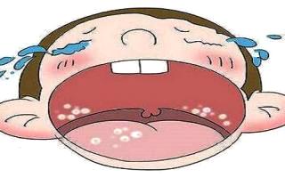 小儿推拿宝妈需警惕孩子口腔细菌感染小儿鹅口疮