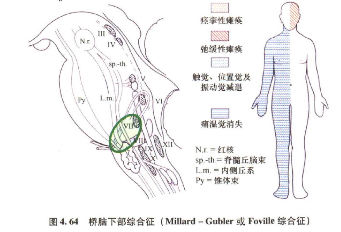 常见的脑干综合征-桥脑(之二(原创)_周长帅