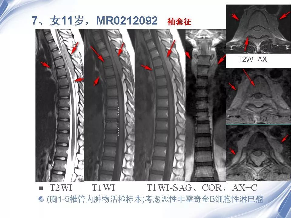 脊柱原发性恶性淋巴瘤的影像诊断影像天地