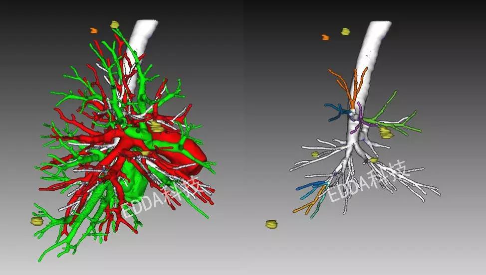 心中有数刀下有路edda科技iqqa3d胸肺临床应用集锦篇