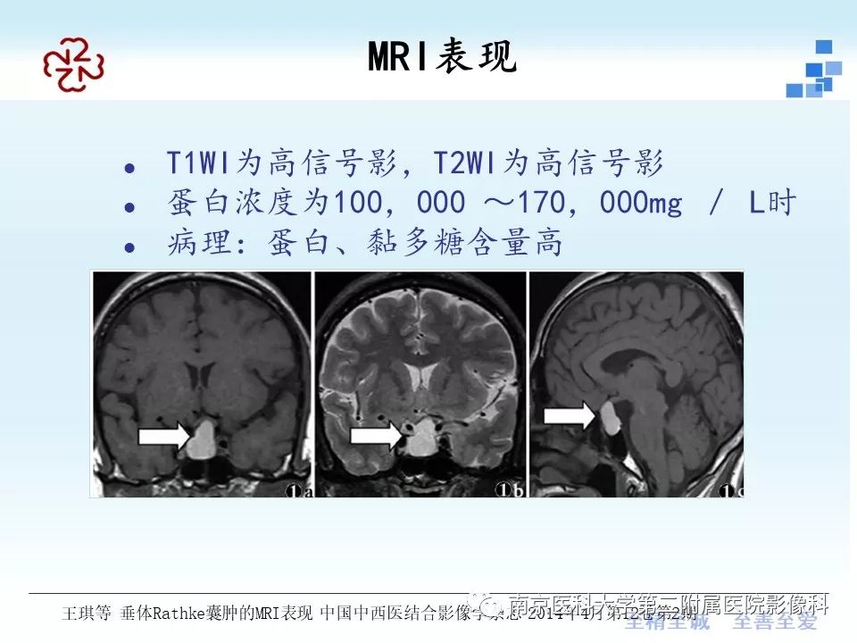 史上最全垂体rathke囊肿的mri诊断与鉴别