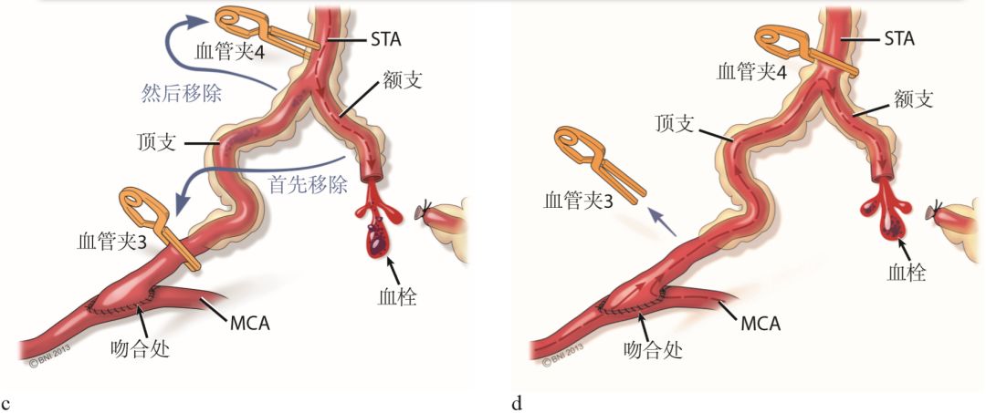 手術示範| 煙霧病直接血運重建術(中)-《煙霧病診斷與治療》連載之二_