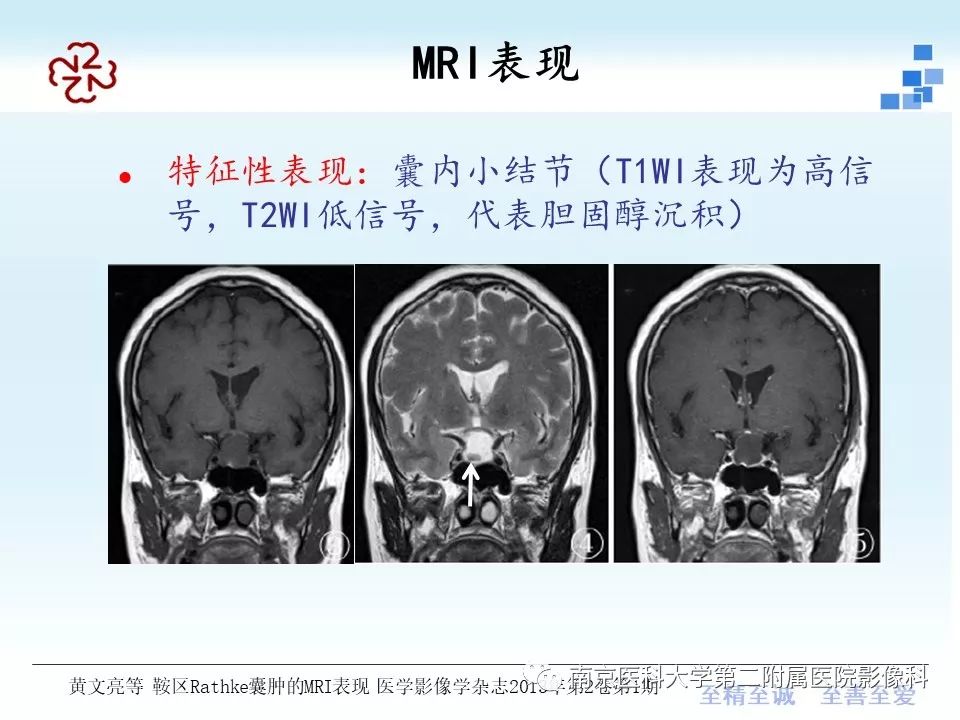 史上最全垂體rathke囊腫的mri診斷與鑑別