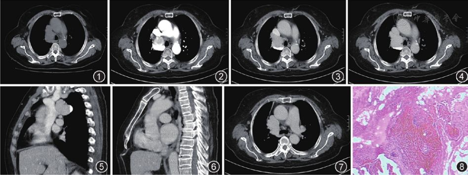 病例报告奇静脉海绵状血管瘤一例