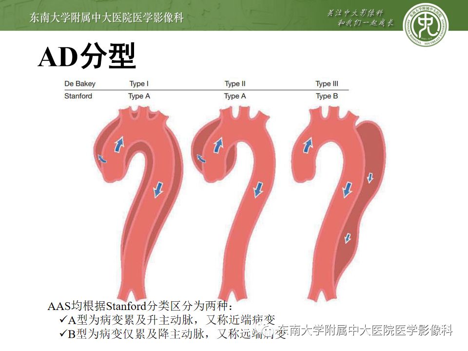 因胸痛21小时入院 ct 增强 编辑/校对:郑孝飞 病例结果:主动脉夹层