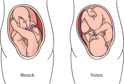 胎儿臀位八个月图片
