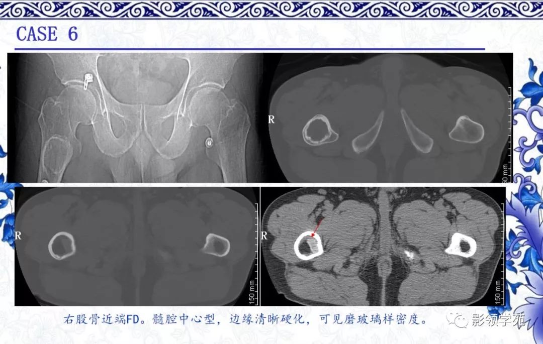 骨性成分由不规则弯曲小梁状的编织骨(罕见板层骨)构成纤维组织主要由