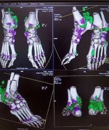 工欲善其事必先利其器双能ct让痛风元凶现形