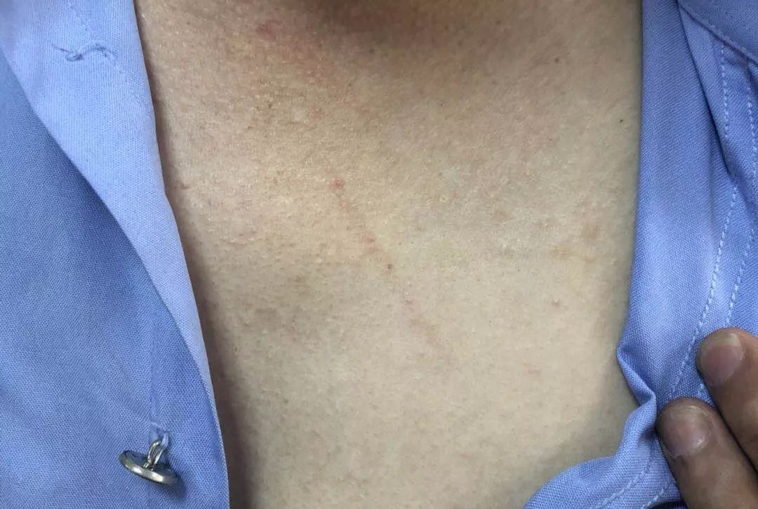 徐警官脖子左下方有一条长长的抓痕,尽管是事发第二天,抓痕依然曲晰