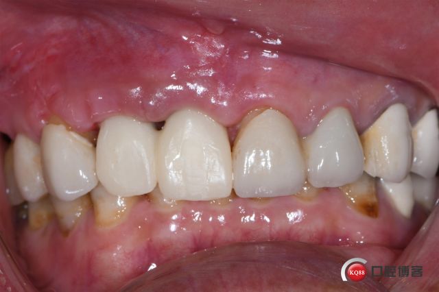 右下下颌第一磨牙多根管一例_种植