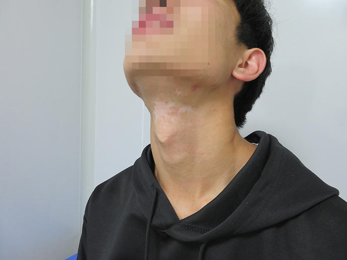 白癜风患者真实案例分析:16岁少年颈部白斑治疗周期图片对比